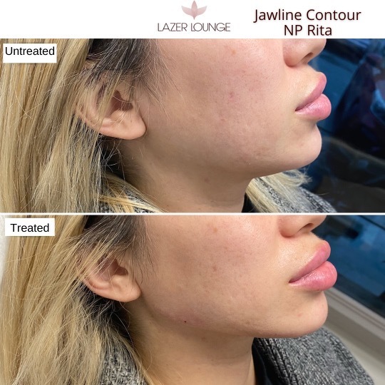 Nonsurgical Jawline Contouring