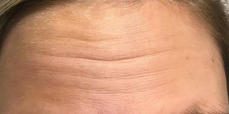 Forehead Lines Treatment With Botox