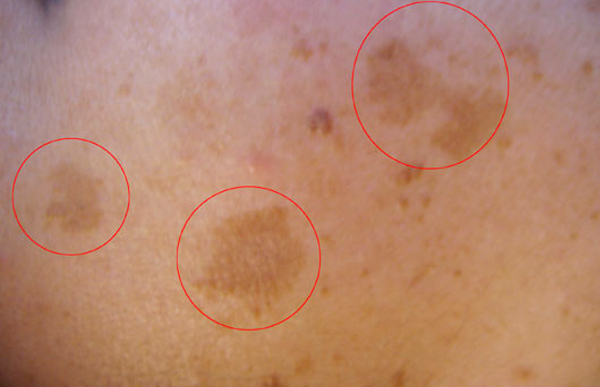 Uneven Skin Tone Spots